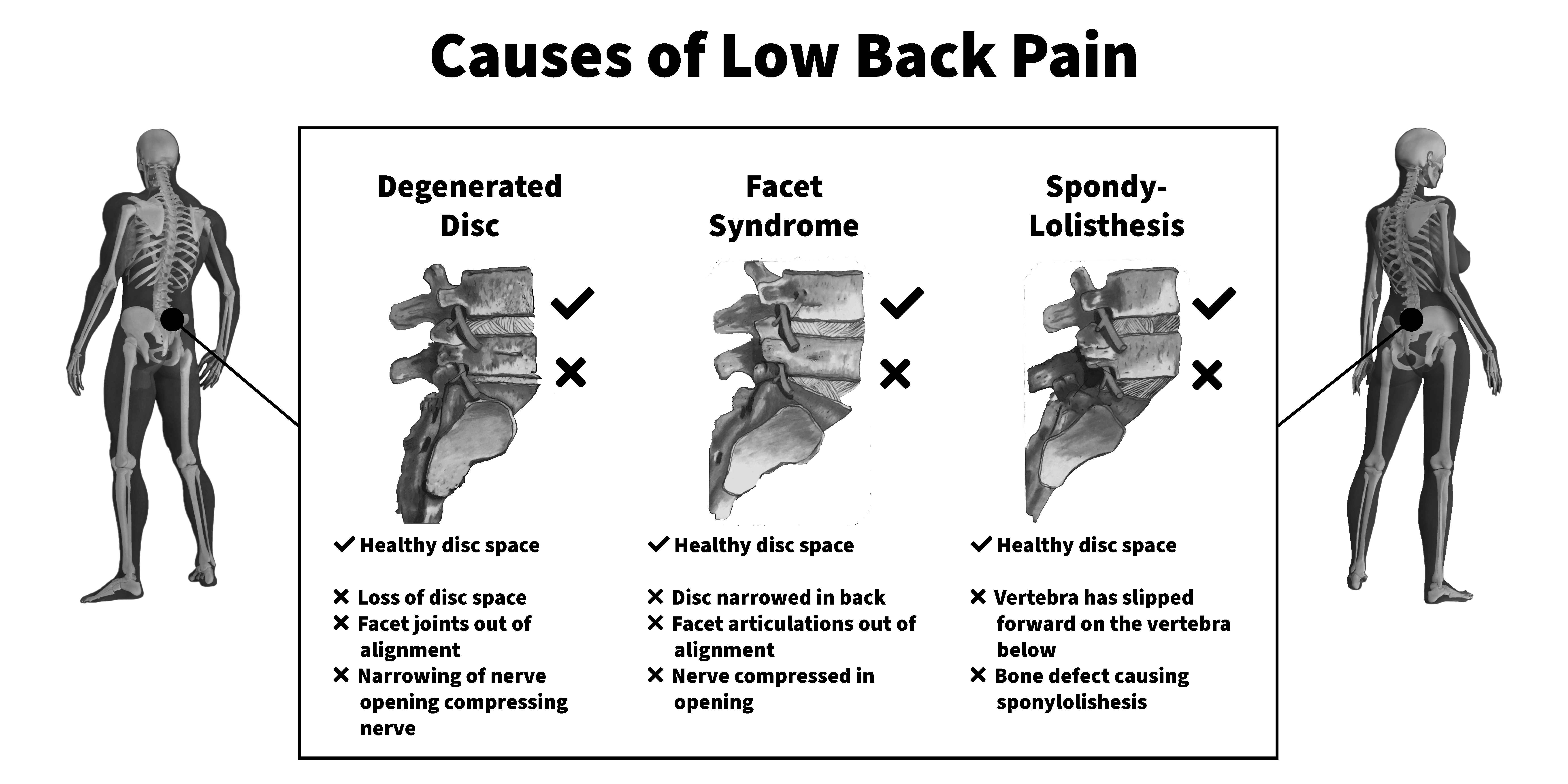 Lower Back Pain Poster